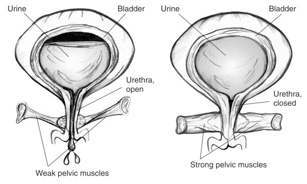 Two anatomical drawings of a bladder. The bladder on the left has weak pelvic floor muscles that allow urine to escape. Labels point to bladder, urine, urethra (open), and weak pelvic muscles. The bladder on the right has strong pelvic floor muscles that