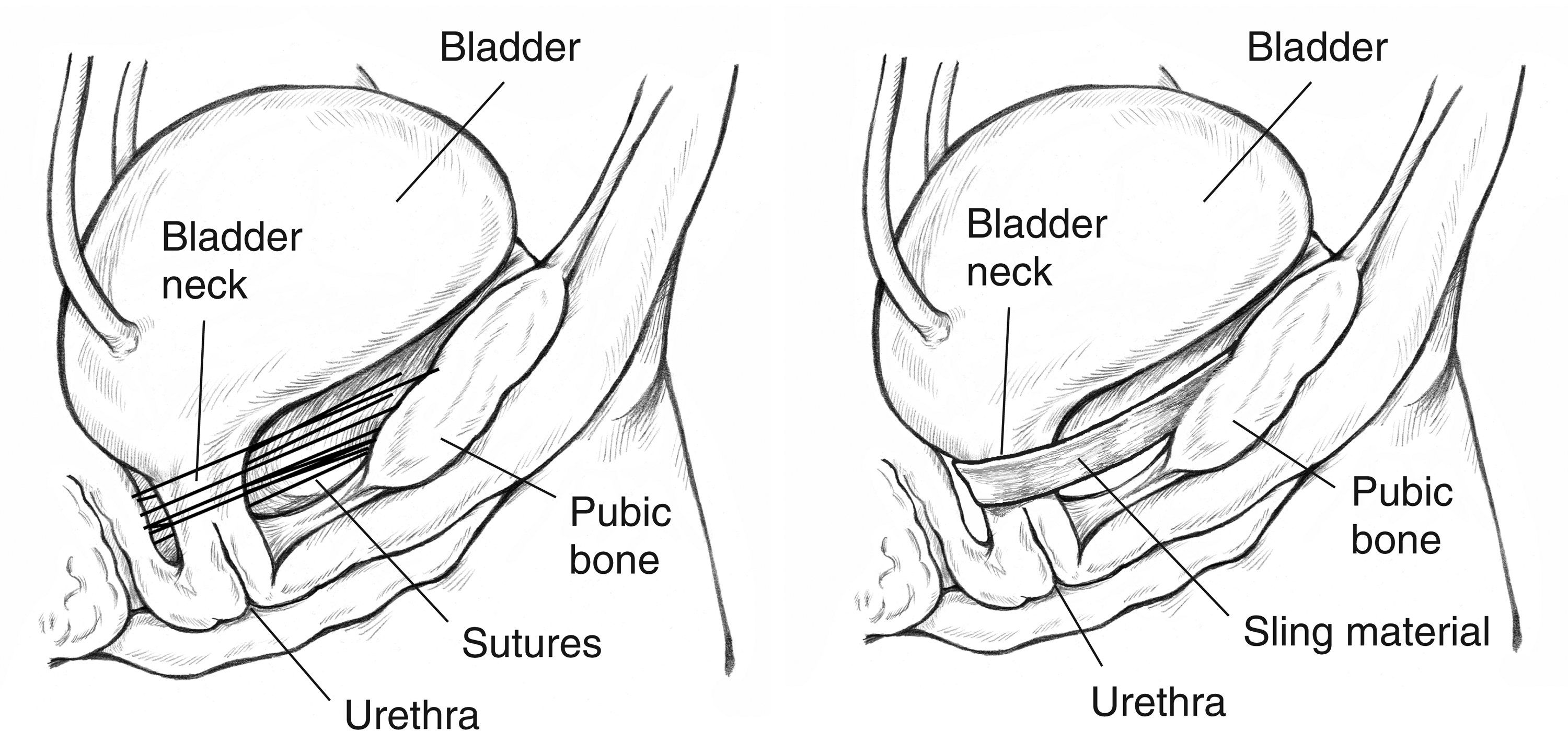 A bladder held in place by sutures and a bladder held in place by a