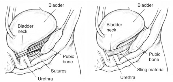 Two diagrams of bladder held in place after surgery. On the left, the bladder is held in place by sutures. Labels point to the bladder, bladder neck, pubic bone, sutures, and urethra. On the right, the bladder is held in place by a sling. Labels point to