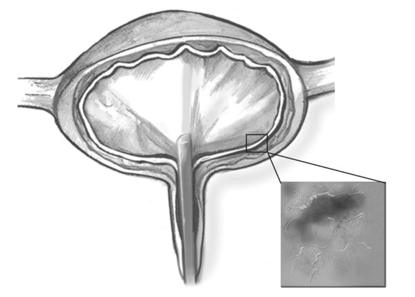 Drawing of cystoscope in the bladder.