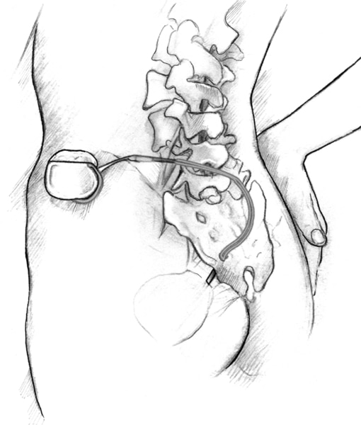 Anatomic drawing that shows the placement of an implanted nerve stimulation device in the lower abdomen of a female patient