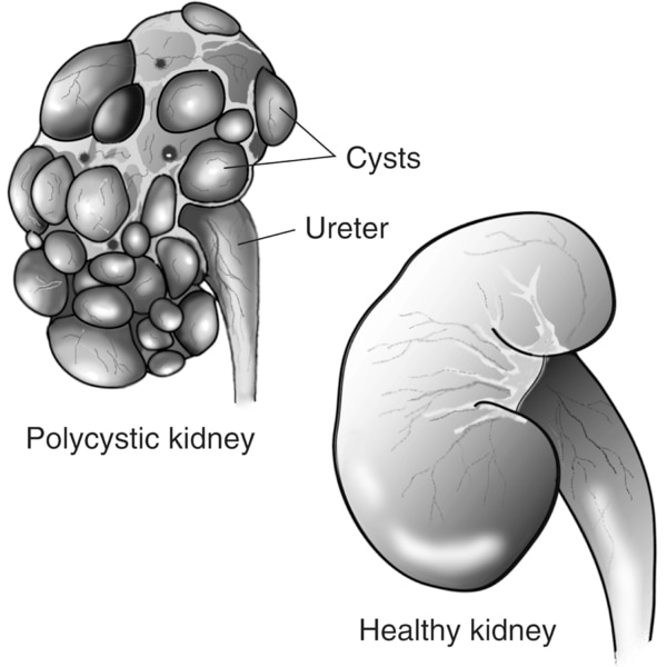 Diagram of two kidneys. The healthy kidney on the lower right is smooth. The polycystic kidney on the upper left has many fluid-filled sacs on the surface. Labels point to the ureter and cysts on the polycystic kidney.