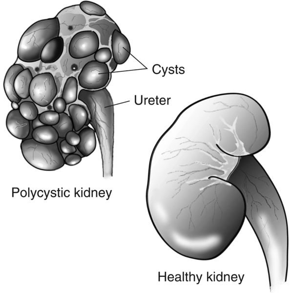 Diagram of two kidneys. The healthy kidney on the lower right is smooth. The polycystic kidney on the upper left has many fluid-filled sacs on the surface. Labels point to the ureter and cysts on the polycystic kidney.