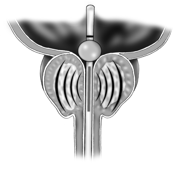 Cross-section diagram of the prostate, bladder, and urethra. A transurethral microwave thermotherapy (TUMT) catheter is in the urethra. The catheter extends all the way into the bladder. A small inflated ball near the end of the catheter keeps the cathete