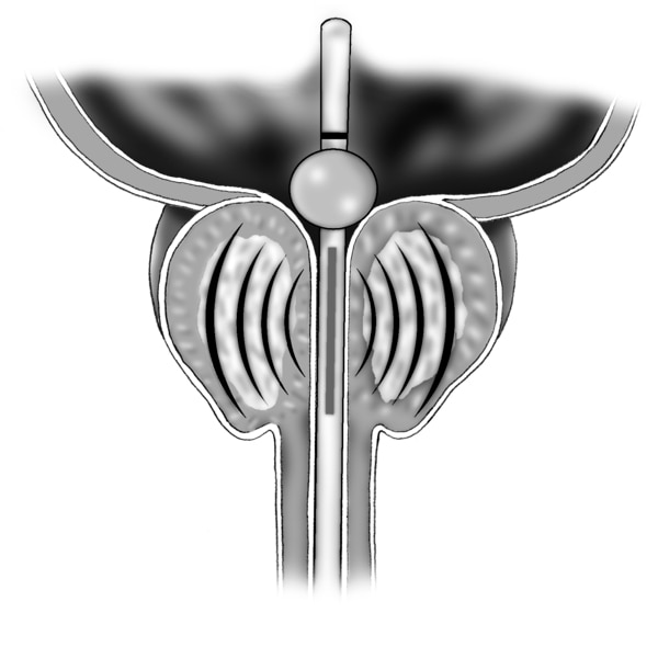 Cross-section diagram of the prostate, bladder, and urethra. A transurethral microwave thermotherapy (TUMT) catheter is in the urethra. The catheter extends all the way into the bladder. A small inflated ball near the end of the catheter keeps the cathete