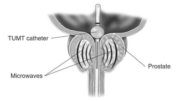 Cross-section diagram of the prostate, bladder, and urethra. A transurethral microwave thermotherapy (TUMT) catheter is in the urethra. The catheter extends all the way into the bladder. A small inflated ball near the end of the catheter keeps the cathete