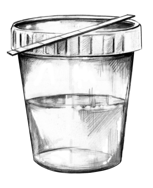 Drawing of a urine sample in a cup and a dipstick for testing the protein content of the urine.