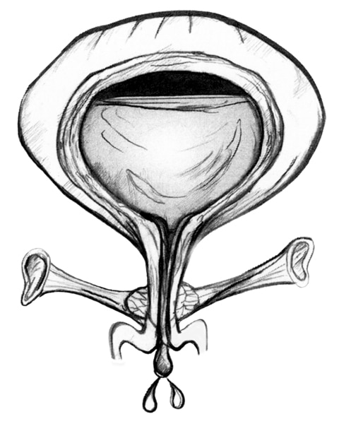 Anatomical drawing of a bladder. The bladder has weak pelvic floor muscles that allow urine to escape.