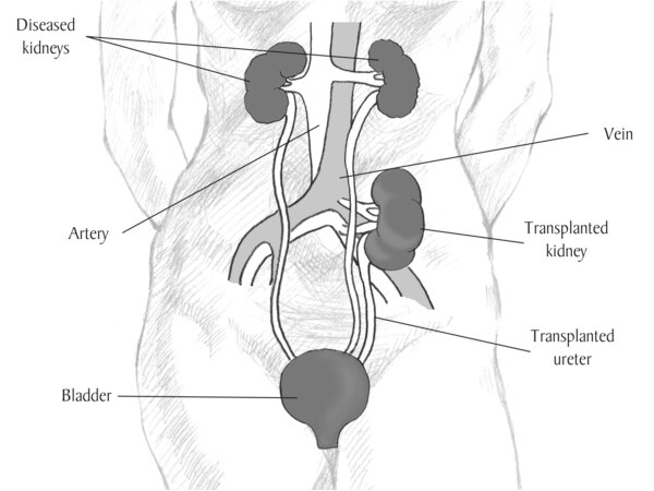 Anatomical diagram of a female figure with a transplanted kidney. The two diseased kidneys are still in place on either side of the spine, just below the rib cage. The transplanted kidney is located on the left side, just above the bladder. A transplanted ureter connects the new kidney to the bladder. Labels point to the diseased kidneys, artery, vein, transplanted kidney, transplanted ureter, and bladder.