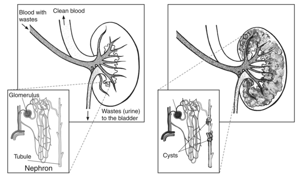 Drawing of a medullary sponge kidney. The large part of the kidney appears to be porous, like a sponge. An inset shows a microscopic view of a nephron with cysts growing on the tubule. Labels point to the cysts.