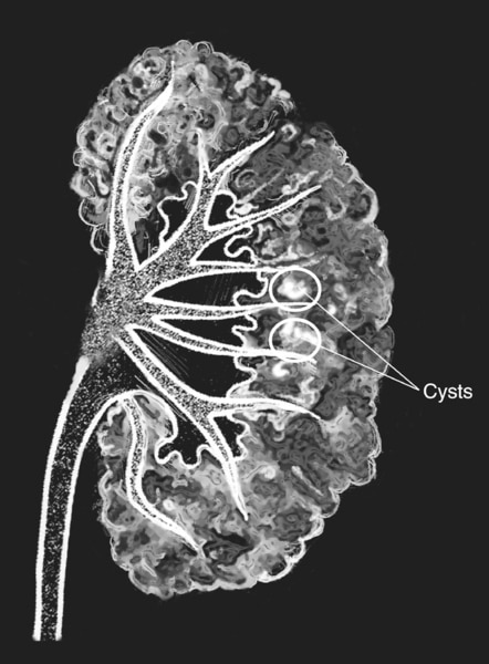 Drawing of a medullary sponge kidney as seen in an intravenous pyelogram. The background is black. The large part of the kidney appears to be porous, like a sponge. Two white spots on the kidney are circled. A label identifies the white spots as cysts.