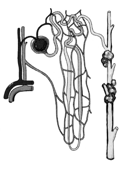 Drawing that shows a microscopic view of a nephron with cysts. Blood vessels are shown on the left side of the picture. A urine-collecting tube is shown on the right side of the picture. In the middle, branching blood vessels intertwine with the branching