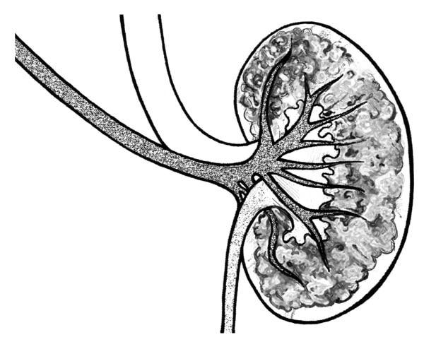 Drawing of a medullary sponge kidney. The large part of the kidney appears to be porous, like a sponge.