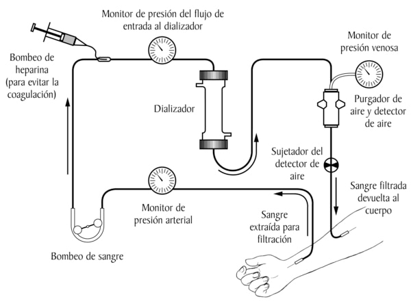 Una diagrama del circuito extracorporeo de la hemodialisis. Las etiquetas senalan la sangre extraida para filtracion, el monitor de presion arterial, el bombeo de sangre, el bombeo heparina para prevenir la coagulacion, el dializador, el monitor de presio