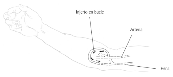 Ilustracion de un brazo con un injerto en bucle. Las etiquetas senalan hacia la arteria y la vena. Un tubo encorvado, etiquetado como injerto de bucle, se conecta con la arteria hacia la vena. Las flechas senalan la direccion del flujo de sangre desde la
