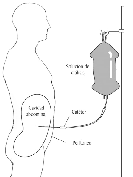 Un diagrama de un paciente recibiendo dialisis peritoneal. Las etiquetas senalan la solucion de dialisis, el peritoneo y la cavidad abdominal. La solucion de dialisis gotea mediante el cateter hacia una bolsa de plastico en la cavidad abdominal.
