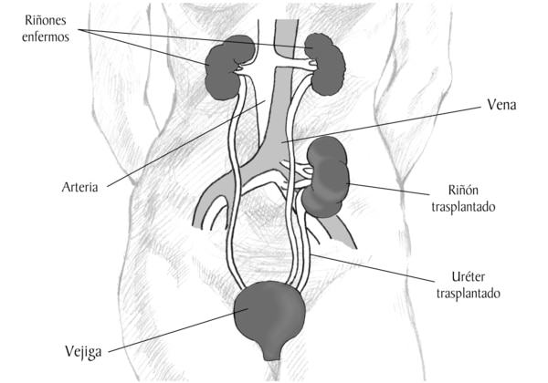 Un diagrama que muestra la localizacion de un rinon donado en la parte superior del abdomen. Las etiquetas senalan a los rinones, la arteria, la vena, el rinon transplantado, el ureter transplantado y la vejiga.