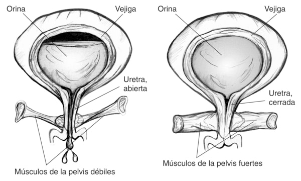 Dos ilustraciones anatomicas de la vejiga. La vejiga en la izquierda tiene musculos debiles del suelo pelvico que permiten que la orina escape. Se etiqueta la vejiga, la orina y la uretra (abierta) y musculos debiles de la pelvis. La vejiga en la derecha