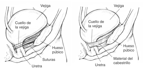 Dos diagramas de la vejiga sostenida en su lugar luego de una cirugia. En la izquierda, la vejiga se mantiene en el puesto con suturas. Se etiqueta la vejiga, el cuello de la vejiga, el hueso pubico, el material del cabestrillo y la uretra.