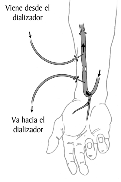 Un ilustracion de un antebrazo con una fistula arteriovenosa. Las flechas muestran la direccion del flujo de sangre. Dos agujas se insertan en la fistula. Las etiquetas explican que una aguja lleva la sangre hacia la maquina del dializador. La otra regres