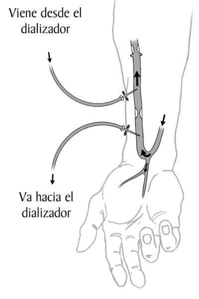 Un ilustracion de un antebrazo con una fistula arteriovenosa. Las flechas muestran la direccion del flujo de sangre. Dos agujas se insertan en la fistula. Las etiquetas explican que una aguja lleva la sangre hacia la maquina del dializador. La otra regres
