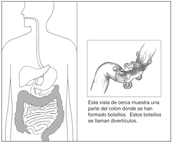 Ilustración del sistema digestivo resaltando el colon. A un lado hay una sección en primer plano del colon don diverticulis o bolsillos.
