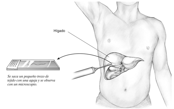 Ilustración de un torso masculino que muestra el lugar donde penetra la aguja para extirpar un pequeño trozo de tejido del hígado. Una toma agrandada muestra un pedazo de hígado en una platina que será analizado bajo un microscopio.