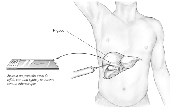 Ilustración de un torso masculino que muestra el lugar donde penetra la aguja para extirpar un pequeño trozo de tejido del hígado. Una toma agrandada muestra un pedazo de hígado en una platina que será analizado bajo un microscopio.