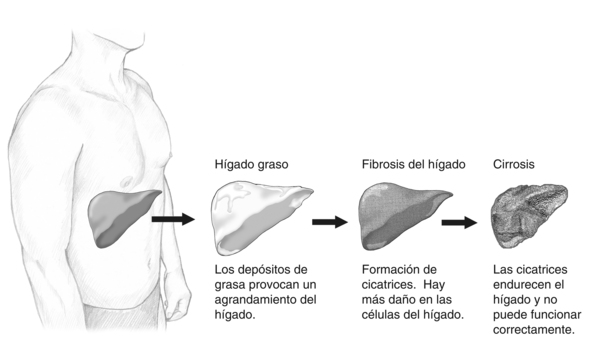 Ilustración de las etapas de daño al hígado que muestra un hígado normal; un hígado graso, donde los depósitos de grasa causan el agrandamiento del hígado; la fibrosis, en la cual se forman cicatrices en el tejido y existe daño celular al hígado; y la cirrosis, en la cual los tejidos con cicatrices endurecen al hígado y éste deja de funcionar adecuadamente.