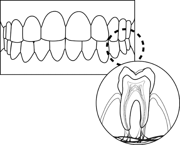 Ilustración de los dientes, las encías y un diente. Una parte de la ilustración se etiqueta para mostrar los dientes y las encías. Otra parte de la ilustración se etiqueta para ensenar una toma trasversal del diente y la encia.