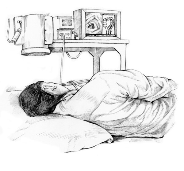 Drawing of a colonoscopy patient.