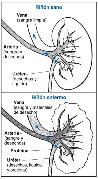 Ilustración de dos riñones con cortes transversales con las partes y funciones etiquetadas que muestran un riñón enfermo y un riñón saludable.