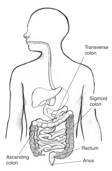 Drawing of the gastrointestinal tract with labels pointing to the ascending colon, transverse colon, sigmoid colon, rectum, and anus. The ascending colon and the sigmoid colon are shaded.