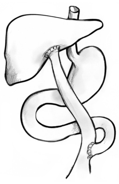 Drawing of the Kasai procedure used to treat biliary atresia. Part of the small intestine is attached to the liver and replaces the bile ducts so the liver can drain properly.