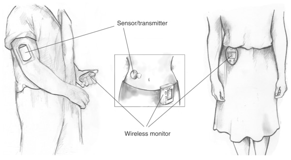 Drawing of three people, each using a different type of wireless continuous glucose monitoring system. A man on the left wears a glucose sensor/transmitter on his right arm and holds a monitor in his left hand. In the middle drawing, a woman’s torso is shown with a sensor/transmitter on her abdomen and a monitor clipped to the top of her pants. A woman on the right wears a third type of monitor outside her clothing; the sensor/transmitter is worn beneath her clothing so it is not pictured.