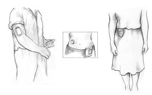 Drawing of three people, each using a different type of wireless continuous glucose monitoring system. A man on the left wears a glucose sensor/transmitter on his right arm and holds a monitor in his left hand. In the middle drawing, a woman’s torso is shown with a sensor/transmitter on her abdomen and a monitor clipped to the top of her pants. A woman on the right wears a third type of monitor outside her clothing; the sensor/transmitter is worn beneath her clothing so it is not pictured.