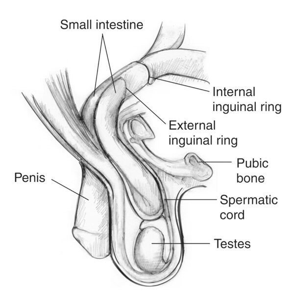 Drawing of an inguinal hernia with the small intestine, internal inguinal ring, external inguinal ring, pubic bone, penis, spermatic cord, and testes labeled.