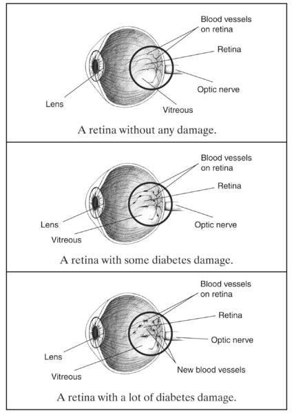 Drawing of a cross section of an eye showing no diabetes damage with the retina, blood vessels on the retina, the optic nerve, the vitreous, and the lens labeled. Drawing of a cross section of an eye showing some diabetes damage with the retina, blood vessels on the retina, the optic nerve, the vitreous, and the lens labeled. Drawing of a cross section of an eye showing a lot of diabetes damage with the retina, blood vessels on the retina, the optic nerve, new blood vessels, the vitreous, and the lens labeled.