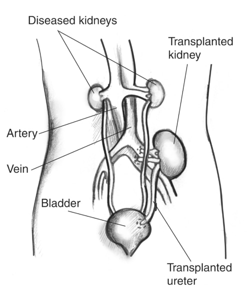 Anatomical diagram of a female figure with a transplanted kidney. The two diseased kidneys are still in place on either side of the spine, just below the rib cage. The transplanted kidney is located on the left side, just above the bladder. A transplanted ureter connects the new kidney to the bladder. Labels point to the diseased kidneys, artery, vein, transplanted kidney, transplanted ureter, and bladder.