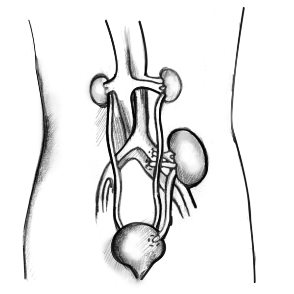 Anatomical diagram of a female figure with a transplanted kidney. The two diseased kidneys are still in place on either side of the spine, just below the rib cage. The Picture of a transplanted kidney inside an outline of the abdomen. The two damaged kidneys are still in place on either side of the spine, just below the rib cage. The transplanted kidney is located on the left side, just above the bladder. A transplanted ureter connects the new kidney to the bladder. Labels point to the damaged kidneys, transplanted kidney, bladder, and transplanted ureter.
