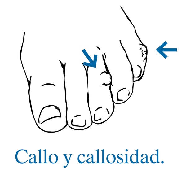 Ilustración de un pie con flechas que señalan un callo y una callosidad.