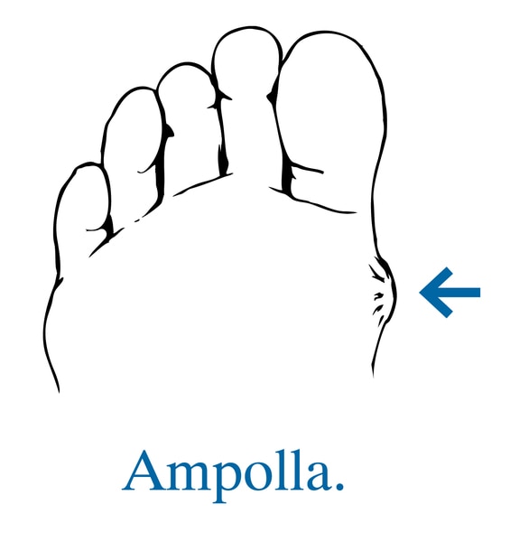Ilustración de un pie con una flecha que señala una ampolla.