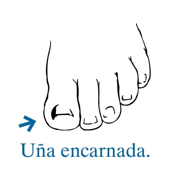 Ilustración de un pie con una flecha que señala hacia una uña encarnada en el dedo gordo.