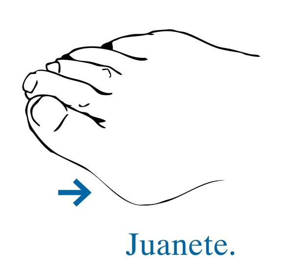 Ilustración de un pie con una flecha que señala hacia un juanete.