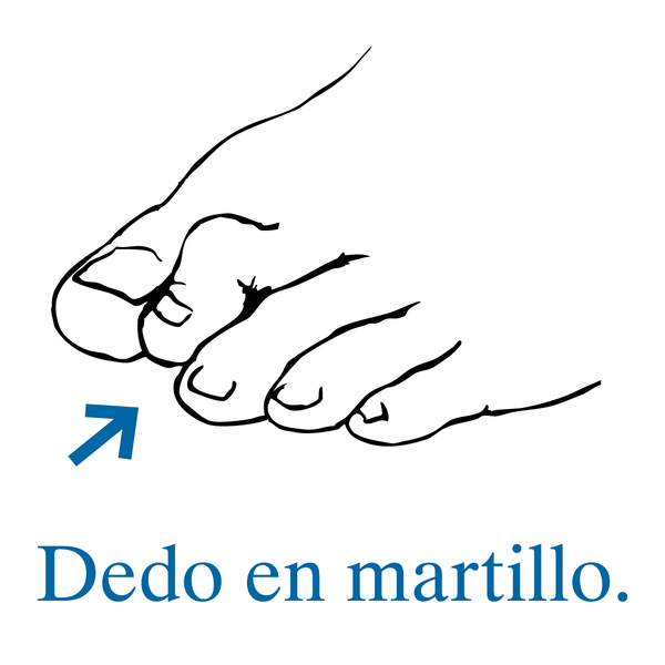 Ilustración de un pie con una flecha que señala hacia un dedo en martillo.
