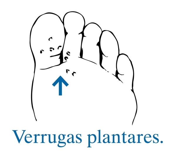 Ilustración de la planta de un pie con una flecha que señala hacia verrugas plantares.