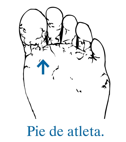 Ilustración de la planta de un pie con una flecha que señala hacia el pie de atleta.