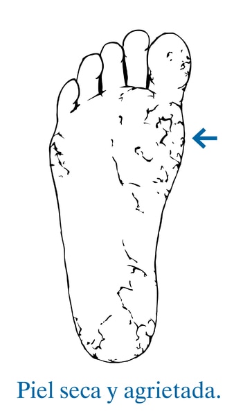 Ilustración de la planta de un pie con una flecha que señala hacia la piel seca y agrietada.