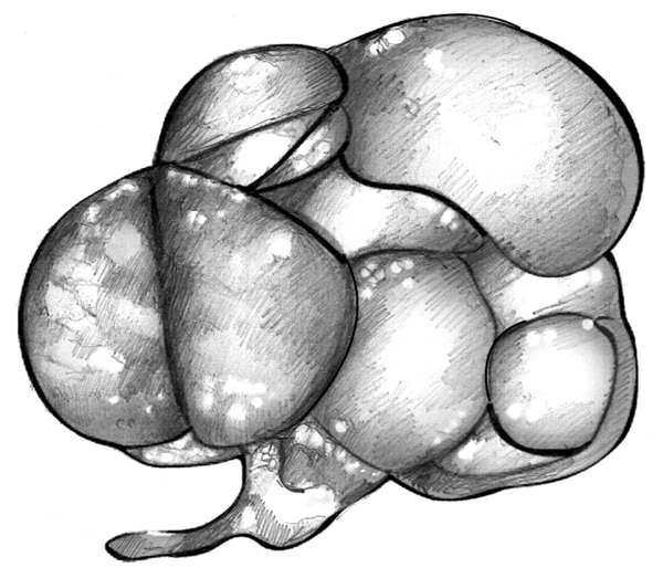 Drawing of a kidney with dysplasia. The dysplastic kidney appears as a cluster of different-sized cysts.