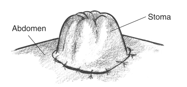 Drawing of a stoma with the stoma and the abdomen labeled.